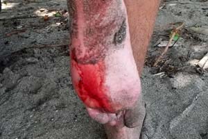 Rays hide in the sand, if you step on them it can result in an injury like this. Do the stingray shuffle to avoid stings,  slide your feet along the sand instead of taking steps.